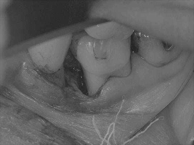 歯周病で吸収してしまった骨を再生療法で再生させた症例