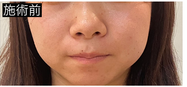 施術前(正面・下顔面)
