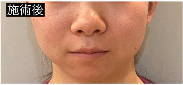 施術後(正面・下顔面)